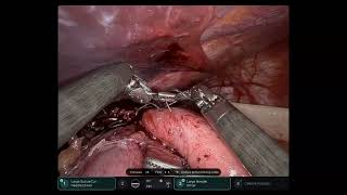 Robotic Toupet Fundoplication Technique [upl. by Gordan]