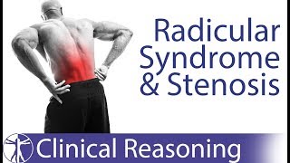 Lumbar Radicular Syndrome vs Intermittent Neurogenic ClaudicationStenosis [upl. by Adele]