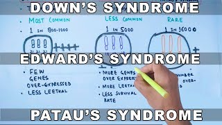 Trisomy  Downs vs Edwards vs Pataus Syndrome [upl. by Jaye]