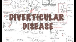 Diverticular Disease diverticulitis  Overview [upl. by Barnabe444]