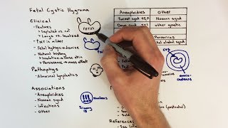 Fetal Cystic Hygroma [upl. by Euh]