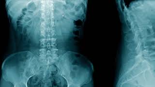 bowelstomach wall gastrocolic ligament psoas muscles [upl. by Sissy]