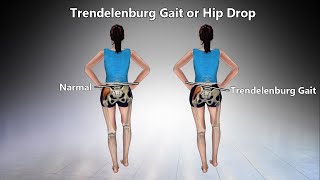 Trendelenburg Gait  Definition Causes Characteristics Diagnosis Treatment [upl. by Nerua97]