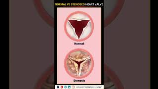 Normal vs Narrowed Stenosed Heart Valve education neet biology heart [upl. by Etnauq]