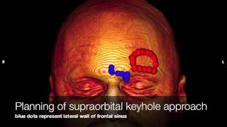 Supraorbital keyhole approach for resection of oligoastrocytoma II [upl. by Nuawaj]