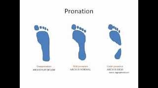 What Is Overpronation [upl. by Meredith998]