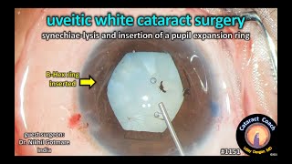 CataractCoach 1151 dense whie cataract with uveitis and synechiae [upl. by Isaak275]