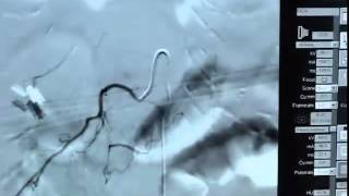 Spinal ArterAngio 033012mp4 [upl. by Aicilyt503]