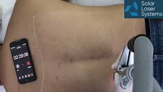 EVOLINE laser  Speed test for black hair removal Video [upl. by Iruam]