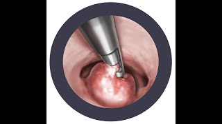 Endometrial Polypectomy with HTRs Hysteroscopic Tissue Removal system  TruClear 5C System [upl. by Risay517]