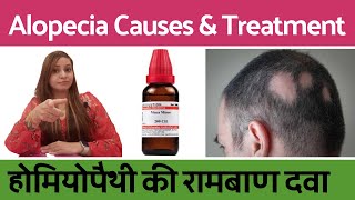 Alopecia Areata treatment  alopecia ka ilaj  alopecia areata homeopathic treatment in hindi [upl. by Mel]