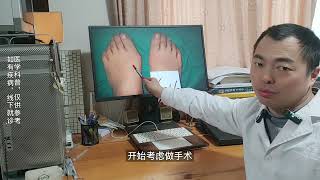 hallux valgus 拇趾外翻后续会发展到怎么样？拇外翻的发展及变化 [upl. by So]