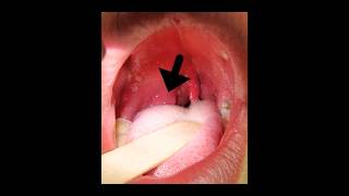 Complication of Tonsillitis Quinsy aka Peritonsillar abscess mbbs next [upl. by Ellerrehc]