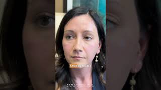 Removing UnderEye Filler Before Trifecta Lift  Dr Kami Parsa [upl. by Assirhc]