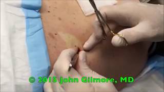 20Minute Abscess Removal Popping Zits Cysts Infections amp Pimples 👍 [upl. by Nwahsear]