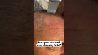 Deep pore cleansing facial treatment in London shorts london blackheads pimplepopping facial [upl. by Ettesus203]