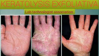 Everything you know about keratolysis exfoliativa [upl. by Dudden]