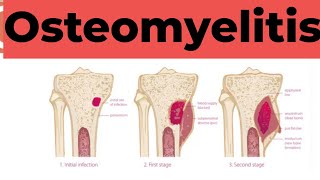 Osteomyelitis  Causes Sign and Symptoms Diagnosis amp Treatment Pathology [upl. by Aliwt]