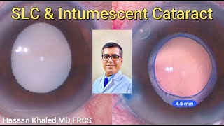 SLC amp intumescent Cataract [upl. by Juliet]