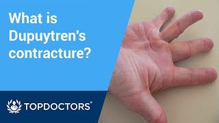 What is Dupuytren’s contracture [upl. by Asikal]