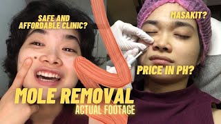 FACIAL MOLE REMOVAL  SURGERY METHOD  PRICE REVEAL [upl. by Gildas]