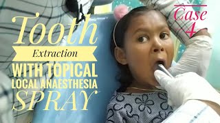 Tooth Extraction with Topical Local Anesthesia SPRAY [upl. by Arrio]