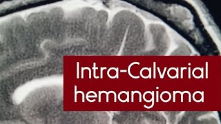 IntraCalvarial hemangioma on MRI scan  osseous venous lowflow vascular malformations mri [upl. by Eydie72]