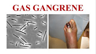 Gas Gangrene [upl. by Honor]