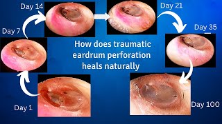 How does traumatic eardrum perforation heals [upl. by Clemmie]