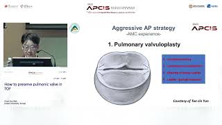 How to preserve pulmonic valve in TOF [upl. by Leverett575]