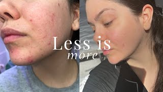 NOT Having a Skincare Routine Saved My Skin [upl. by Mad313]