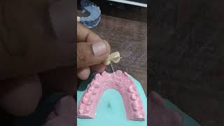 Zirconia bridge dentalclinic art trendingshorts [upl. by Monahan107]