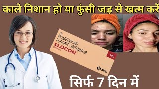 elocon ointment use in hindi mometasone ointment [upl. by Tifanie]