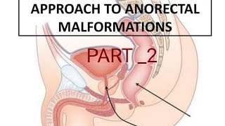 Anorectal Malformation Part  2 [upl. by Innig140]