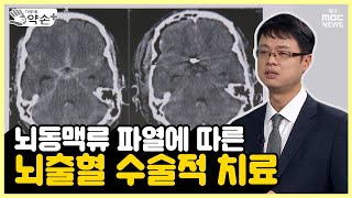 뇌동맥류 파열에 따른 뇌출혈 수술적 치료 늦으면 위험하다 뇌혈관 질환 진단과 치료 ⑫  메디컬 약손 [upl. by Aitrop]