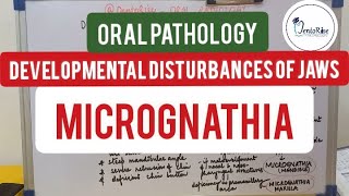 oralpathology  DEVELOPMENTAL DISTURBANCES OF JAWS  MICROGNATHIA Shafers [upl. by Nee]