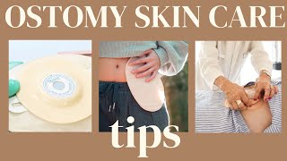 Ostomy Skin Care Tips Less is more ostomytips stoma ostomy [upl. by Llechtim]