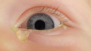 How to treat a sticky eye in a baby [upl. by Iphigeniah]