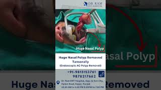 Huge Nasal Polyp Removed Tansorally Endoscopic AC Polyp Removal ent [upl. by Enerehs590]