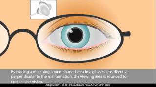 Cylinder in Prescription Glasses Astigmatism Correction [upl. by Aryc]