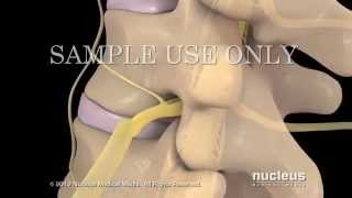 Lesiones de disco lumbar y tratamiento [upl. by Raye]