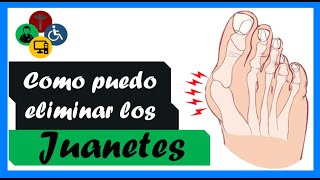 JUANETES en los pies como ELIMINARLOS [upl. by Blainey305]