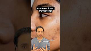 Are Acne Scars Permanent Dr Solomon explains how to treat them  Dr Medispa [upl. by Ahsita]