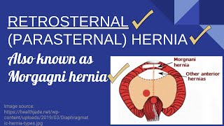 Morgagni Hernia Explained  Retrosternal amp Parasternal Hernia  Novice Medic [upl. by Nyhagen]