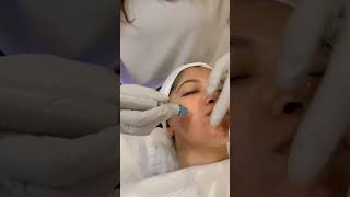 Microneedling  Face Glowing  Cosmothetics  Skin Aesthetic and Dental  Clinic  Lahore [upl. by Adriell180]