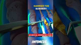 Hammer toe surgery animation  3D medical animintion video shorts 3danimation hammertoes [upl. by Adehsor]