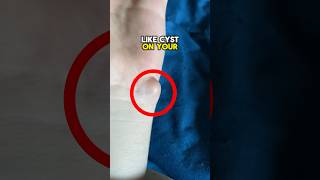 Remove This Dangerous Cyst At Home 😨 viral [upl. by Lapotin]