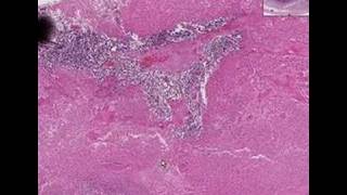 Histopathology Testis Embryonal carcinoma [upl. by Bakerman521]