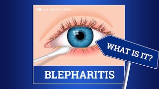 Blepharitis red swollen eyelids Causes Symptoms Treatments [upl. by Nywloc]