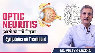 What is Optic Neuritis  Symptoms and Treatment  Synergy Eye Care [upl. by Carling]